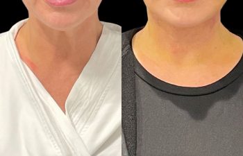 female patient before and after EVELift®