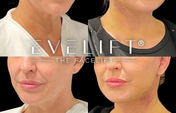 female patient before and after EVELift®