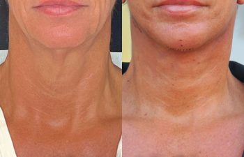 female patient before and after EVELift®