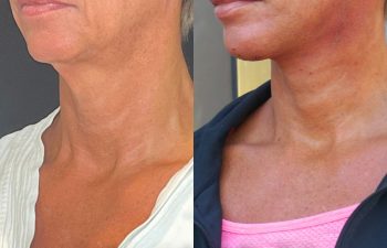 female patient before and after EVELift®