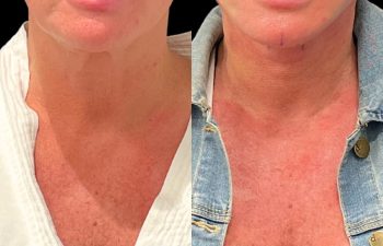 female patient before and after EVELift®