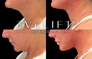 female patient before and after EVELift®
