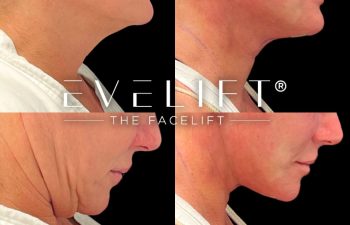 female patient before and after EVELift®