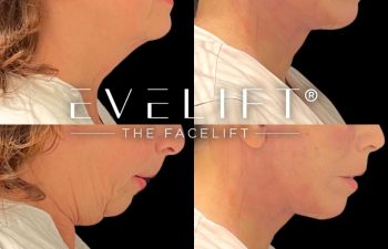 female patient before and after EVELift®