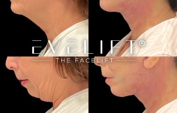 female patient before and after EVELift®