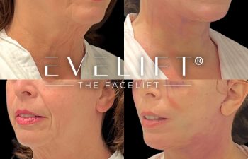 female patient before and after EVELift®