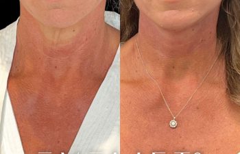 female patient before and after EVELift®