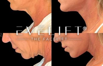 female patient before and after EVELift®