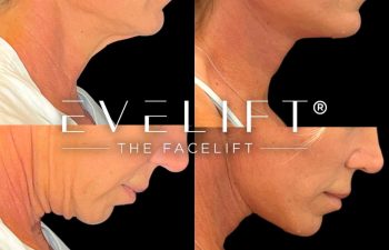 female patient before and after EVELift®
