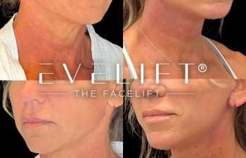 female patient before and after EVELift®