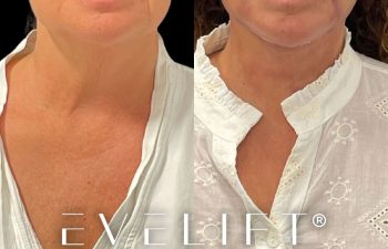 female patient before and after EVELift®
