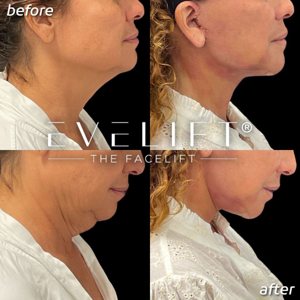female patient before and after EVELift®