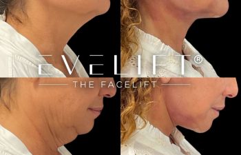 female patient before and after EVELift®