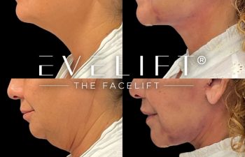 female patient before and after EVELift®