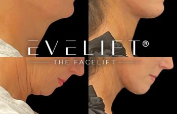 female patient before and after EVELift®