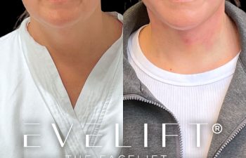 female patient before and after EVELift®