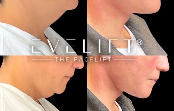 female patient before and after EVELift®