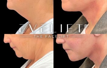 female patient before and after EVELift®