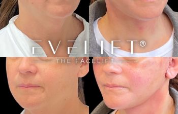 female patient before and after EVELift®