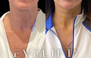 female patient before and after EVELift®