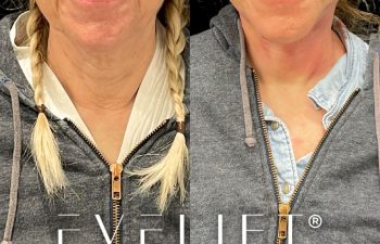 female patient before and after EVELift®