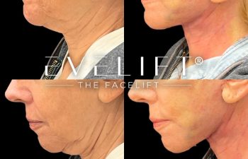 female patient before and after EVELift®
