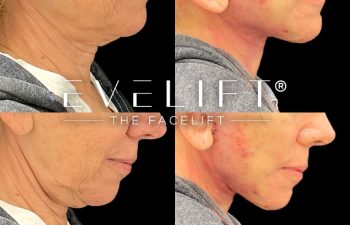 female patient before and after EVELift®