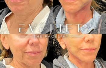 female patient before and after EVELift®