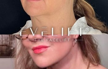 female patient before and after EVELift®