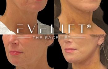 female patient before and after EVELift®
