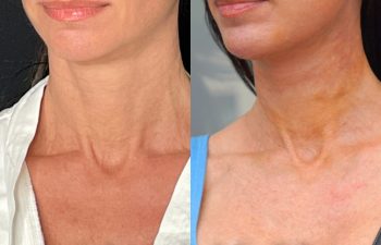 female patient before and after EVELift®