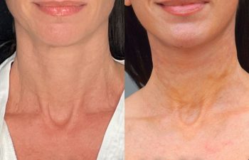 female patient before and after EVELift®