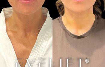 female patient before and after EVELift®