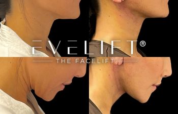 female patient before and after EVELift®