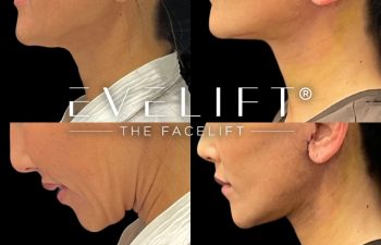 female patient before and after EVELift®