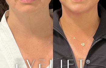 female patient before and after EVELift®