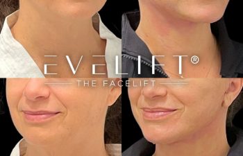 female patient before and after EVELift®