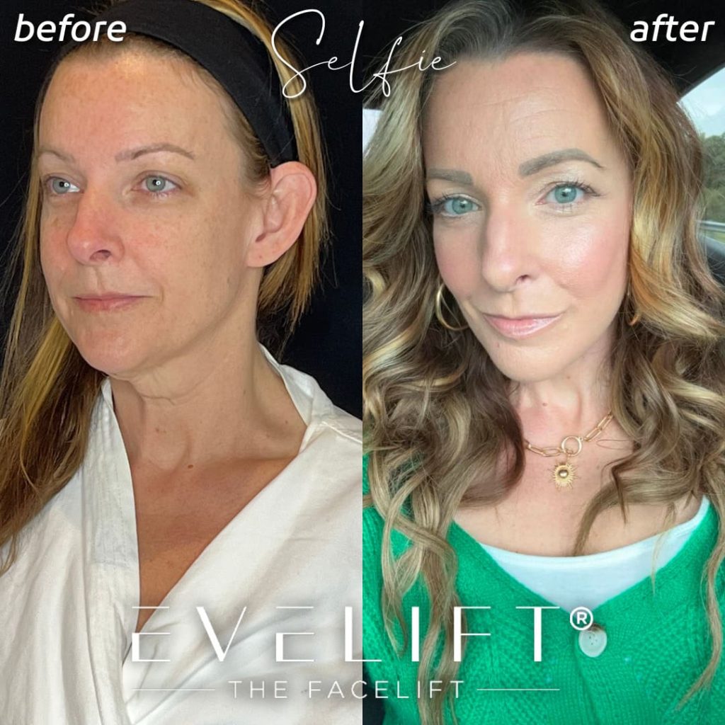 female patient before and after EVELift®
