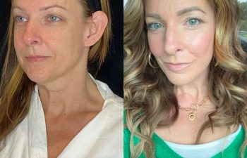 female patient before and after EVELift®