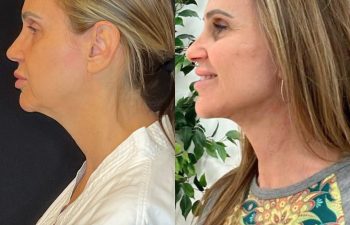 female patient before and after EVELift®