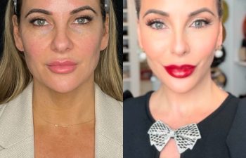 female patient before and after EVELift®