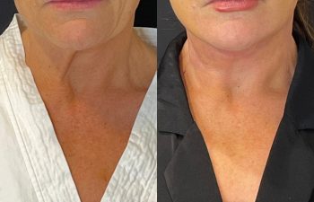 female patient before and after EVELift®
