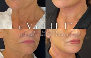 female patient before and after EVELift®