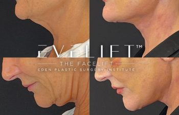 female patient before and after EVELift®