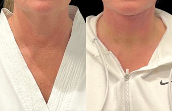 female patient before and after EVELift®
