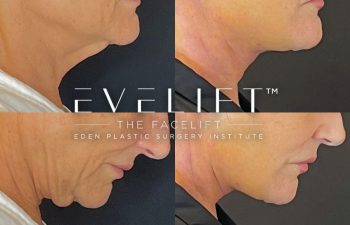 female patient before and after EVELift®