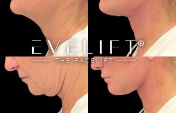 female patient before and after EVELift®