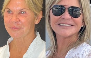 female patient before and after EVELift®