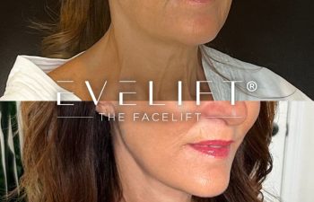female patient before and after EVELift®