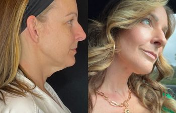 female patient before and after EVELift®